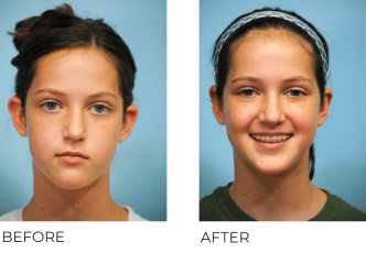 15yr-old female treated with Otoplasty Surgery 2 Months Post-Op