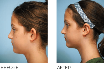 15yr-old female treated with Otoplasty Surgery 2 Months Post-Op