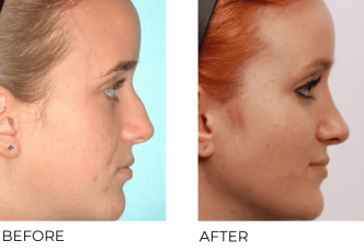 26yr-old female treated with Rhinoplasty Preop 6.30.05, postop 1.15.08