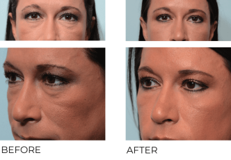 36yr-old female treated with Bilateral Lower Blepharoplasty, 4 months post-op