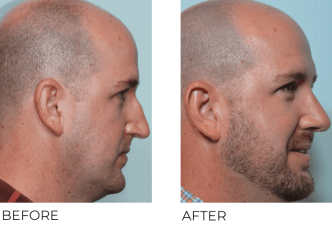39yr-old male treated for rhinoplasty, functional septoplasty, NVR, SMR bilateral turbinates, 10 months post-op