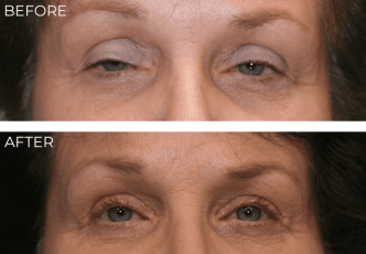 55-64 Year Old Woman Treated with Ptosis Repair 6 months Post-Op