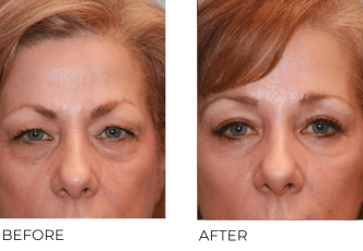 55+yr-old female treated with Blepharoplasty and Endoscopic Brow Lifting 6 Months Post-Op