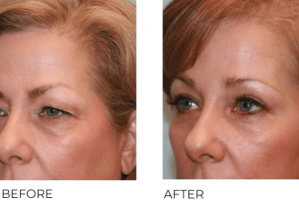 55+yr-old female treated with Blepharoplasty and Endoscopic Brow Lifting 6 Months Post-Op