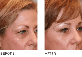 55+yr-old female treated with Blepharoplasty and Endoscopic Brow Lifting 6 Months Post-Op
