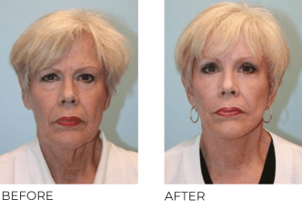 65-74 Year Old Woman Treated with Facelift, Blepharoplasty and Endoscopic Brow Lifting 6 Months Post-Op