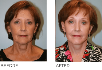 65+yr-old female treated with Facelift, Blepharoplasty and Endoscopic Brow Lifting 6 Months Post-Op