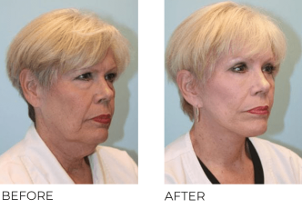 65-74 Year Old Woman Treated with Facelift, Blepharoplasty and Endoscopic Brow Lifting 6 Months Post-Op