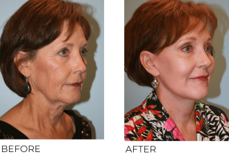 65+yr-old female treated with Facelift, Blepharoplasty and Endoscopic Brow Lifting 6 Months Post-Op