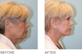 65-74 Year Old Woman Treated with Facelift, Blepharoplasty and Endoscopic Brow Lifting 6 Months Post-Op