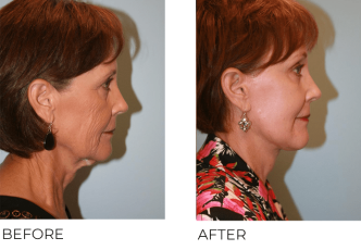 65+yr-old female treated with Facelift, Blepharoplasty and Endoscopic Brow Lifting 6 Months Post-Op