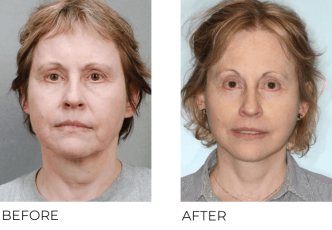 66yr-old female treated with facelift