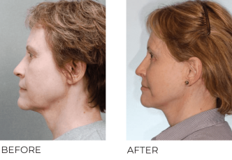 66yr-old female treated with facelift