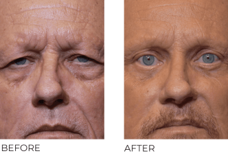 66 year old man treated with Facelift, Cervical Liposuction, Endoscopic Browlift with Tines, Bilateral Upper Blephs, Bilateral Lower Blephs, Cortex, 3 months post-op