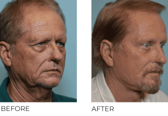 66 year old man treated with Facelift, Cervical Liposuction, Endoscopic Browlift with Tines, Bilateral Upper Blephs, Bilateral Lower Blephs, Cortex, 3 months post-op