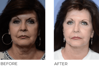 67yr-old female treated with facelift