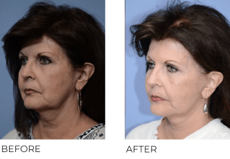 67yr-old female treated with facelift