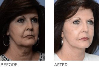 67yr-old female treated with facelift