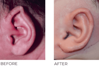 6 week old infant treated for ear deformity with ear well correction left ear, 2 month post opt