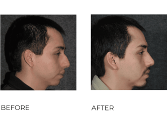 Male treated for Rhinoplasty, 8 week post-op