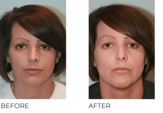18-24 Year Old Woman Treated with Rhinoplasty 1 Year Post-Op