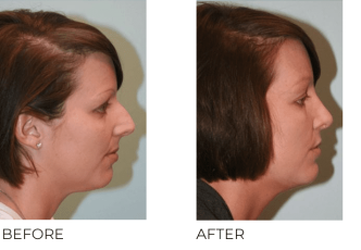 18-24 Year Old Woman Treated with Rhinoplasty 1 Year Post-Op