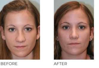 18-24 Year Old Woman Treated with Rhinoplasty 1 Year Post-Op