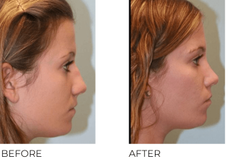 18-24 Year Old Woman Treated with Rhinoplasty 1 Year Post-Op