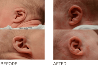1 month old infant treated for BL ear deformity with ear well correction, 4 weeks post correction