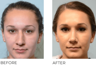 21 year old female who underwent Rhinoplasty- preop 12.11.17, postop 1.10.18