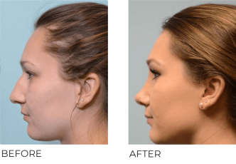 21 year old female who underwent Rhinoplasty- preop 12.11.17, postop 1.10.18