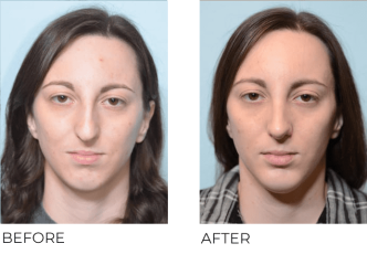 26 year old female who underwent Rhinoplasty with Chin Implant- preop 7.17.17, postop 12.28.17