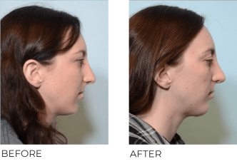 26 year old female who underwent Rhinoplasty with Chin Implant- preop 7.17.17, postop 12.28.17