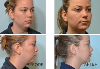28 year old female, contour lift, 1 month postop