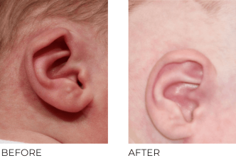 2 week old infant treated for ear deformity with earwell correction right ear, 7 weeks post correction
