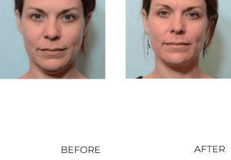 39 year old female, contour lift, 1 month postop