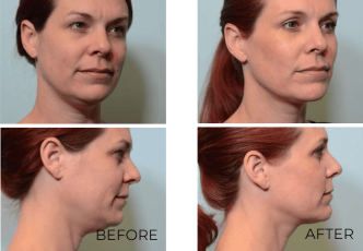 39 year old female, contour lift, 1 month postop