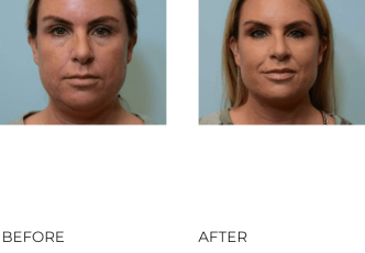 43 year old female, contour lift, 4 weeks postop