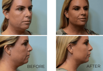 43 year old female, contour lift, 4 weeks postop