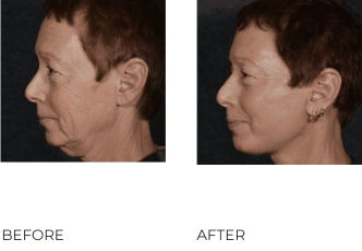 47 year old women treated with facelift 8 weeks post-op