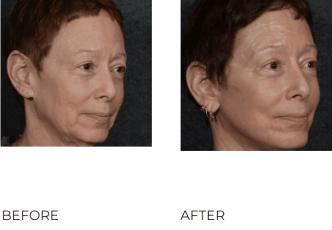47 year old women treated with facelift 8 weeks post-op