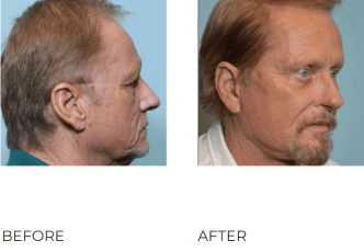 66 year old man treated with Facelift, Cervical Liposuction, Endoscopic Browlift with Tines, Bilateral Upper Blephs, Bilateral Lower Blephs, Cortex, 3 months post-op