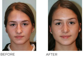 17 or under Year Old Woman Treated with Rhinoplasty 1 year Post-Op