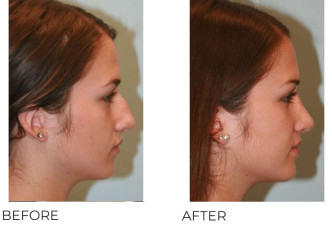 17 or under Year Old Woman Treated with Rhinoplasty 1 year Post-Op