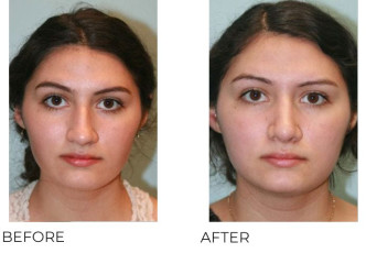 18-24 Year Old Woman Treated with Rhinoplasty 1 Year Post-Op