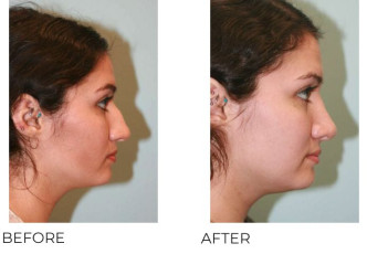 18-24 Year Old Woman Treated with Rhinoplasty 1 Year Post-Op