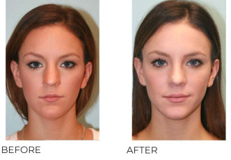 18-24 Year Old Woman Treated with Rhinoplasty 1 Year Post-Op