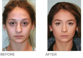 18-24 Year Old Woman Treated with Rhinoplasty 1 Year Post-Op