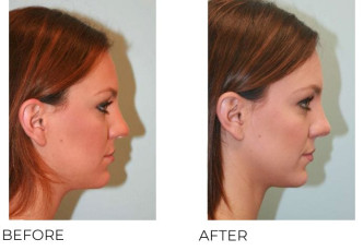 18-24 Year Old Woman Treated with Rhinoplasty 1 Year Post-Op