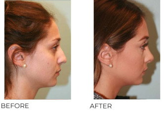 18-24 Year Old Woman Treated with Rhinoplasty 1 Year Post-Op